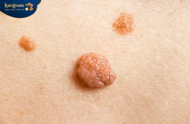 Mụn thịt có hết không? mụn thịt có thể hết được nhưng không tự hết được