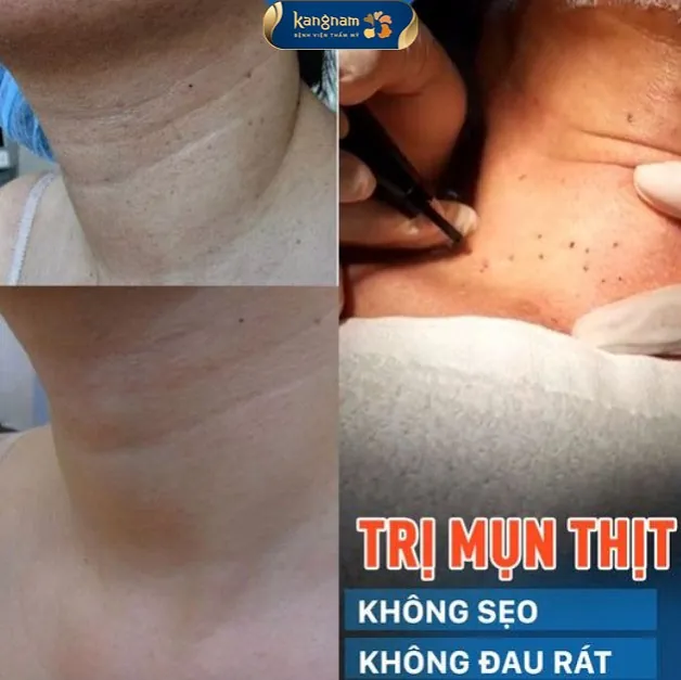 Điều trị mụn thịt bằng phương pháp Laser CO2 Fractional mang lại hiệu quả cao
