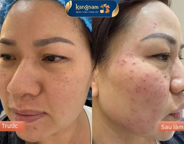 Mụn thịt tại má khi vừa bắn laser