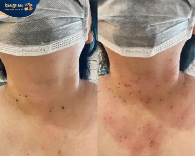 Điều trị mụn thịt ở cổ bằng phương pháp Laser CO2 Fractional