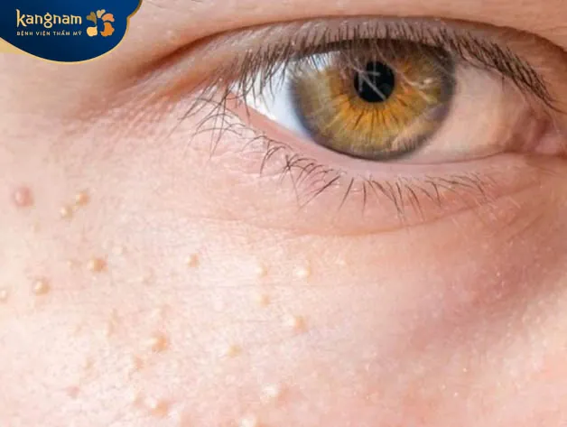 Mụn thịt hình thành như thế nào