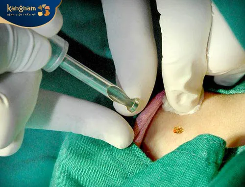 Phẫu thuật điều trị mụn thịt