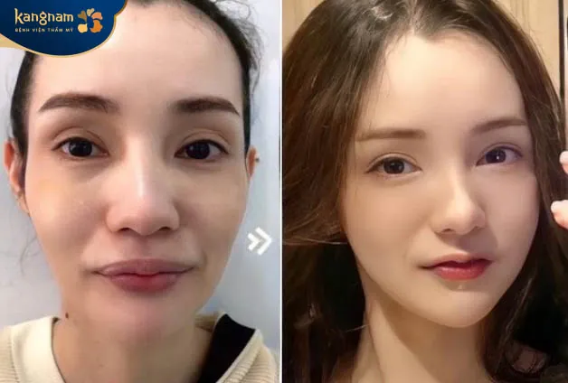 Lựa chọn địa chỉ tiêm filler uy tín, chất lượng để đảm bảo an toàn