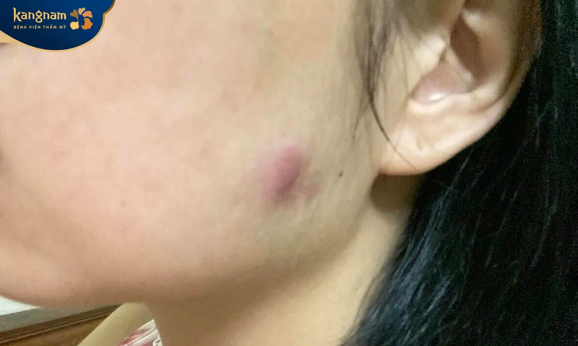 Tình trạng sưng tấy, bầm tím sau tiêm botox