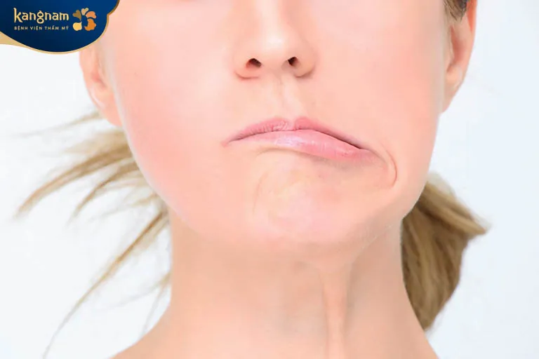 Khuôn mặt đơ cứng, biểu cảm khó khăn