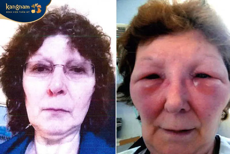 Biến chứng sau tiêm botox do nhiều nguyên nhân