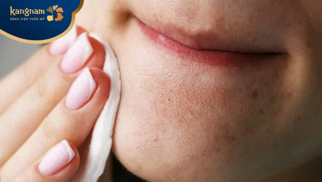 Vệ sinh da không sạch sẽ làm hình thành mụn cám mép miệng