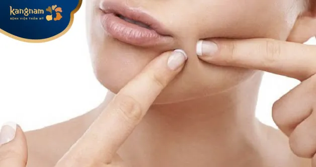 Nặn mụn là một trong những nguyên nhân gây mụn cám