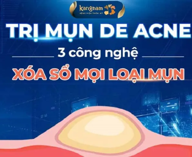 Điều trị bằng công nghệ De Acne tại Kangnam