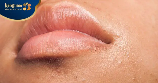 mụn cám mọc ở mép miệng