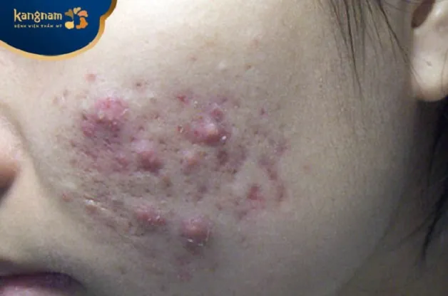 Nên trị mụn tại cơ sở y tế hay điều trị tại nhà?