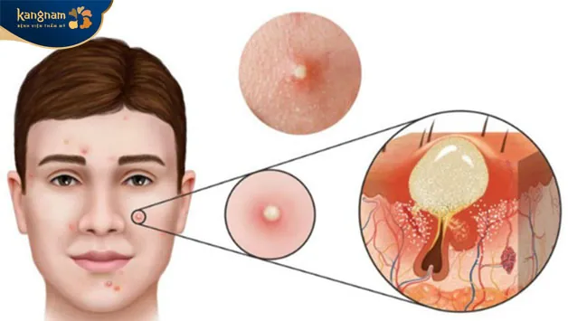 Mụn mủ phát triển từ những nốt mụn trứng cá 