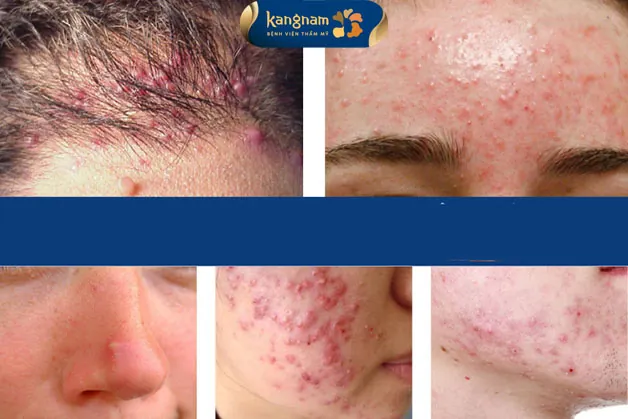 Những vùng da tiết nhiều dầu và bã nhờn có khả năng cao mọc mụn mủ 