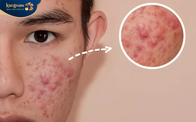 Những tình trạng viêm nhiễm nặng lan ra toàn bộ mặt cần thăm khám bác sĩ càng sớm càng tốt 