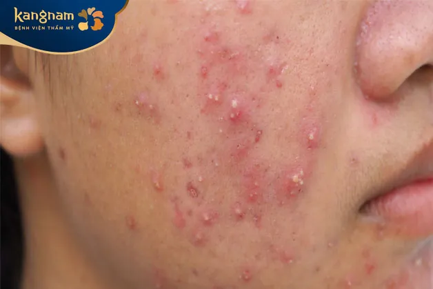 Mụn nang có nên nặn không