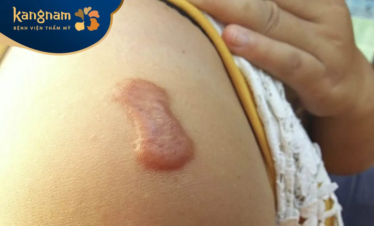 Sẹo lồi hình thành do collagen tăng sinh quá mức