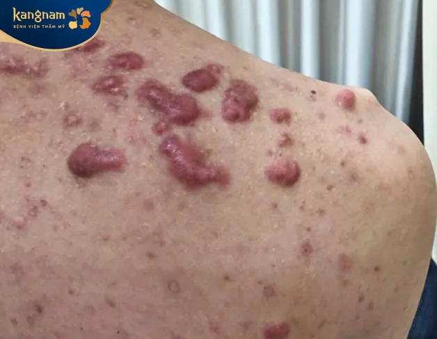 Giá tiền trị sẹo phụ thuộc nhiều vào cấp độ thẹo thực tế của khách hàng 