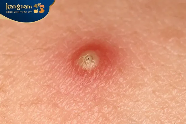 Mụn mủ có mùi hôi xuất phát từ sự tăng sinh của vi khuẩn trong mụn