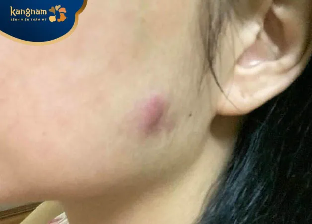 Lạm dụng tiêm botox có thể gây biến chứng nguy hiểm