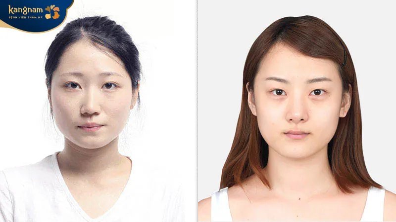 Cơ địa cũng ảnh hưởng đến thời gian duy trì 