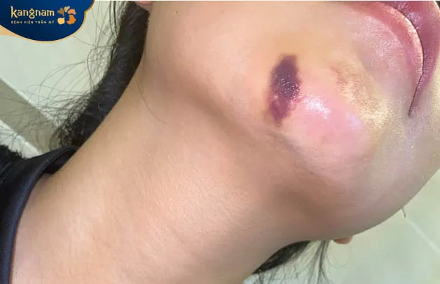 Tụ máu bầm trong thời gian dài