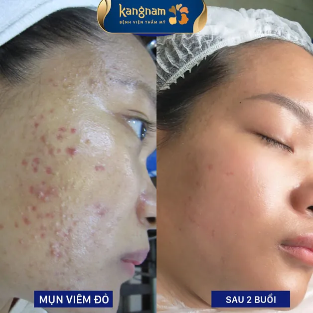 Hết mụn, hết thâm, da sáng khỏe