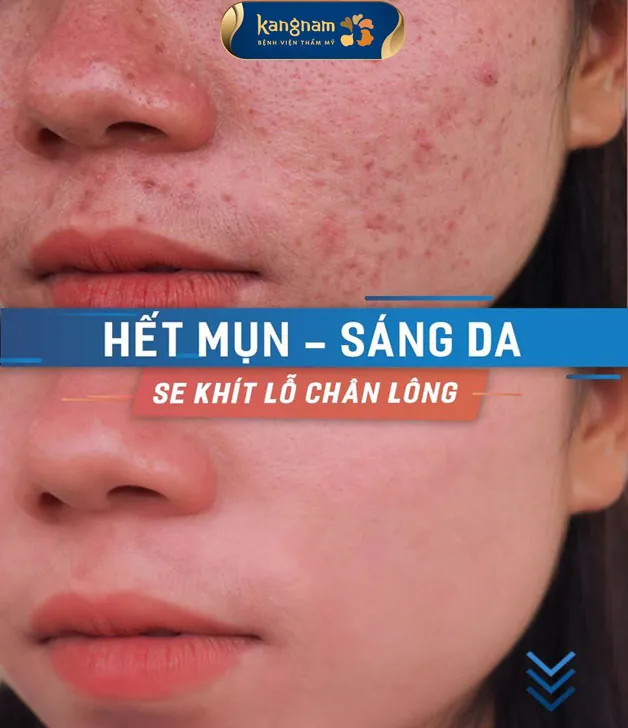 Công nghệ trị mụn tân tiến, tác động tận gốc nguyên nhân gây mụn