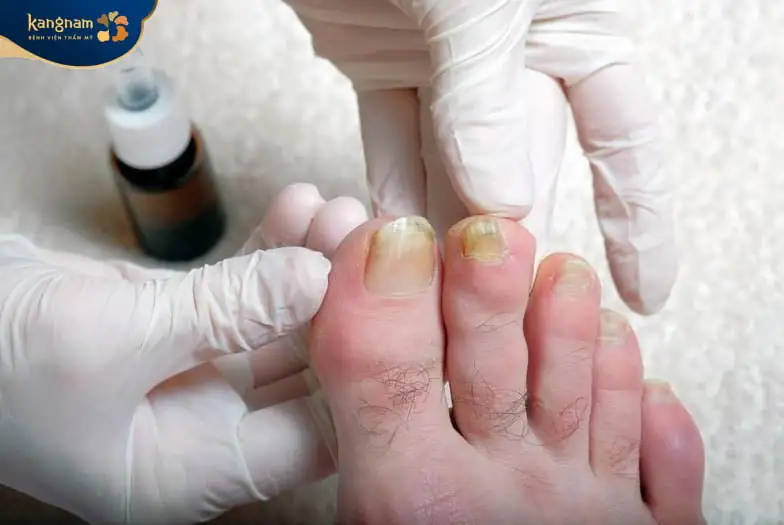 Những biện pháp phòng tránh khóe móng bị sưng mủ