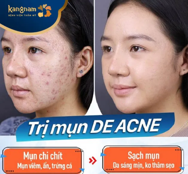 Dịch vụ điều trị mụn De-Acne tân tiến