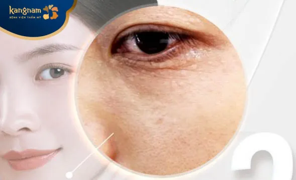 Điều trị mụn thịt/mụn cơm