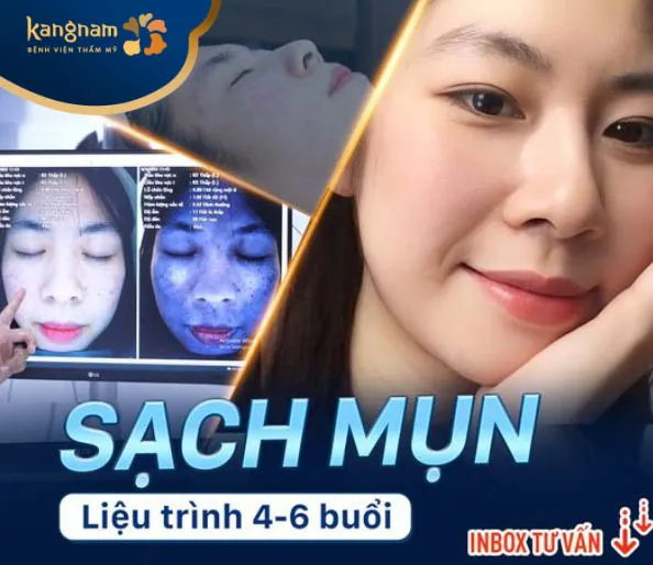 Dịch vụ điều trị mụn tại Kangnam Đà Nẵng