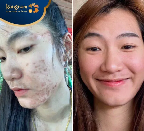 Bạn Thùy Linh chia sẻ hình ảnh về hành trình trị mụn của mình