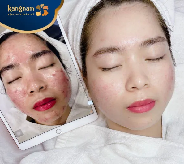 Bạn Như Quỳnh feedback sau trị mụn tại Kangnam Đà Nẵng