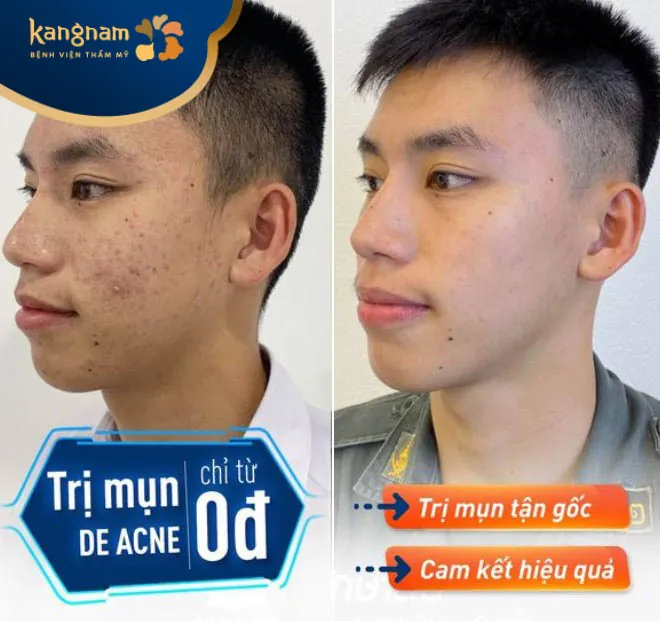 Trị mụn De-Acne tân tiến
