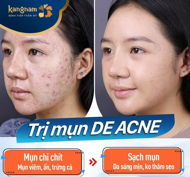 Trị mụn De-Acne tân tiến tại Kangnam