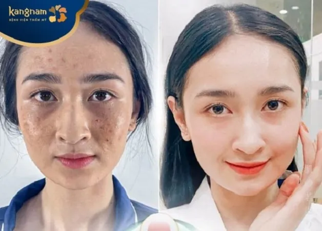 Mụn trứng cá, thâm mụn được khắc phục sau trị mụn