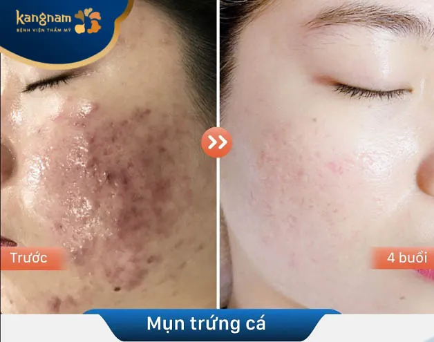 Mụn trứng cá sưng đỏ trên má được loại bỏ