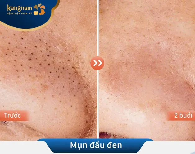 Sạch mụn đầu đen chỉ sau 2 buổi điều trị