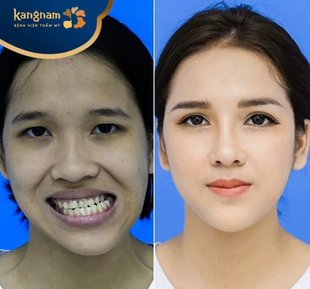 Viện thẩm mỹ Kangnam Hải Phòng là địa chỉ trượt cằm uy tín