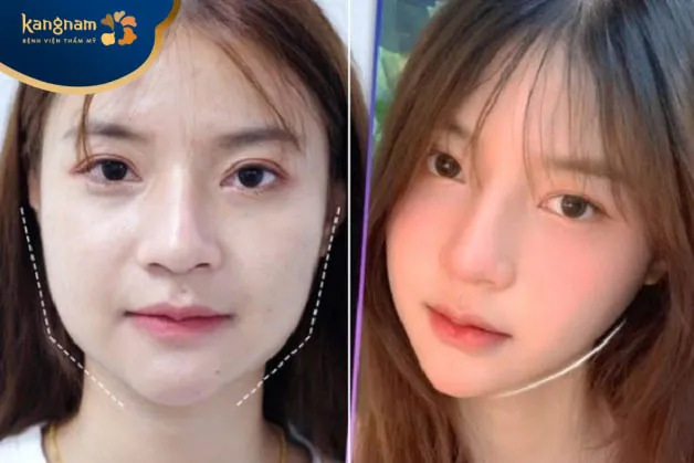 Bạn Thùy Anh chia sẻ sau trượt cằm tại Kangnam Hải Phòng