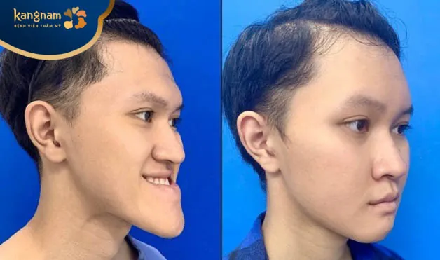 Đức Trung tự tin hơn về ngoại hình sau Phẫu thuật trượt cằm