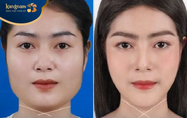 Chị Minh Huyền chia sẻ sau trượt cằm tại Kangnam Hải Phòng