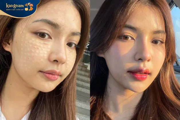 Tiêm Meso có tác dụng sau khoảng 1 tuần