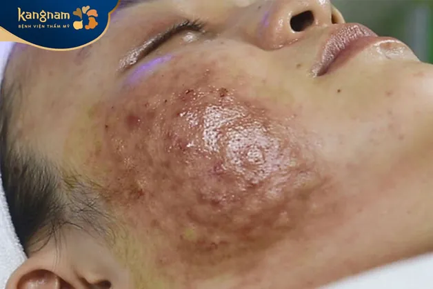 Một số rủi ro khi tiêm Meso có thể dẫn tới Nhiễm trùng da