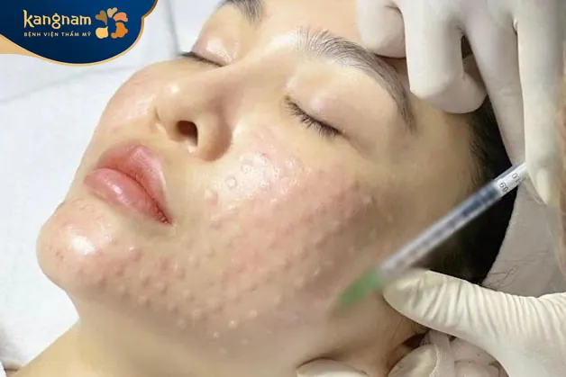 Tiêm Meso không gây hại đến da