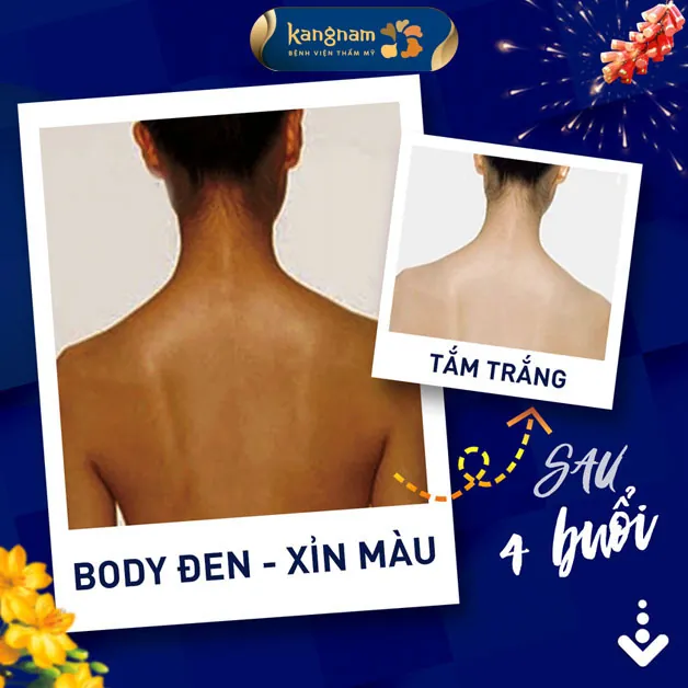 Da đen, không đều màu có thể thực hiện tắm trắng công nghệ Phi thuyền