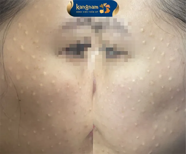 U hạt là biến chứng do cơ địa nhạy cảm phản ứng lại 