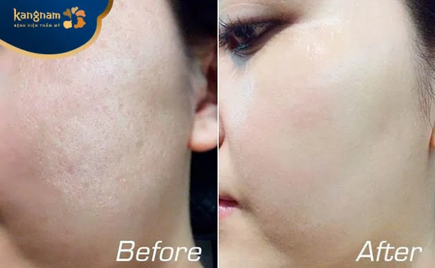 Da trắng sáng, mịn màng sau tiêm meso