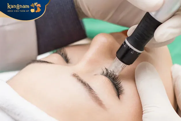 Cấy mi Nano là phương pháp tiên tiến trong làm đẹp