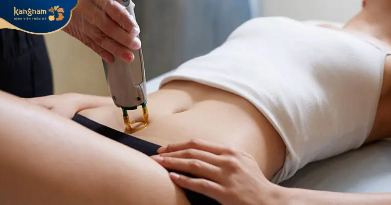 Dịch vụ triệt lông vùng kín được nhiều chị em lựa chọn